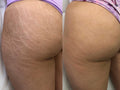 Derma Roller For Stretch Marks