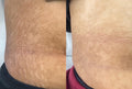 Derma Roller For Stretch Marks