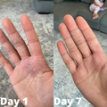 Eczema Relief Cream
