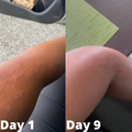 Eczema Relief Cream