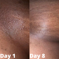 Eczema Relief Cream